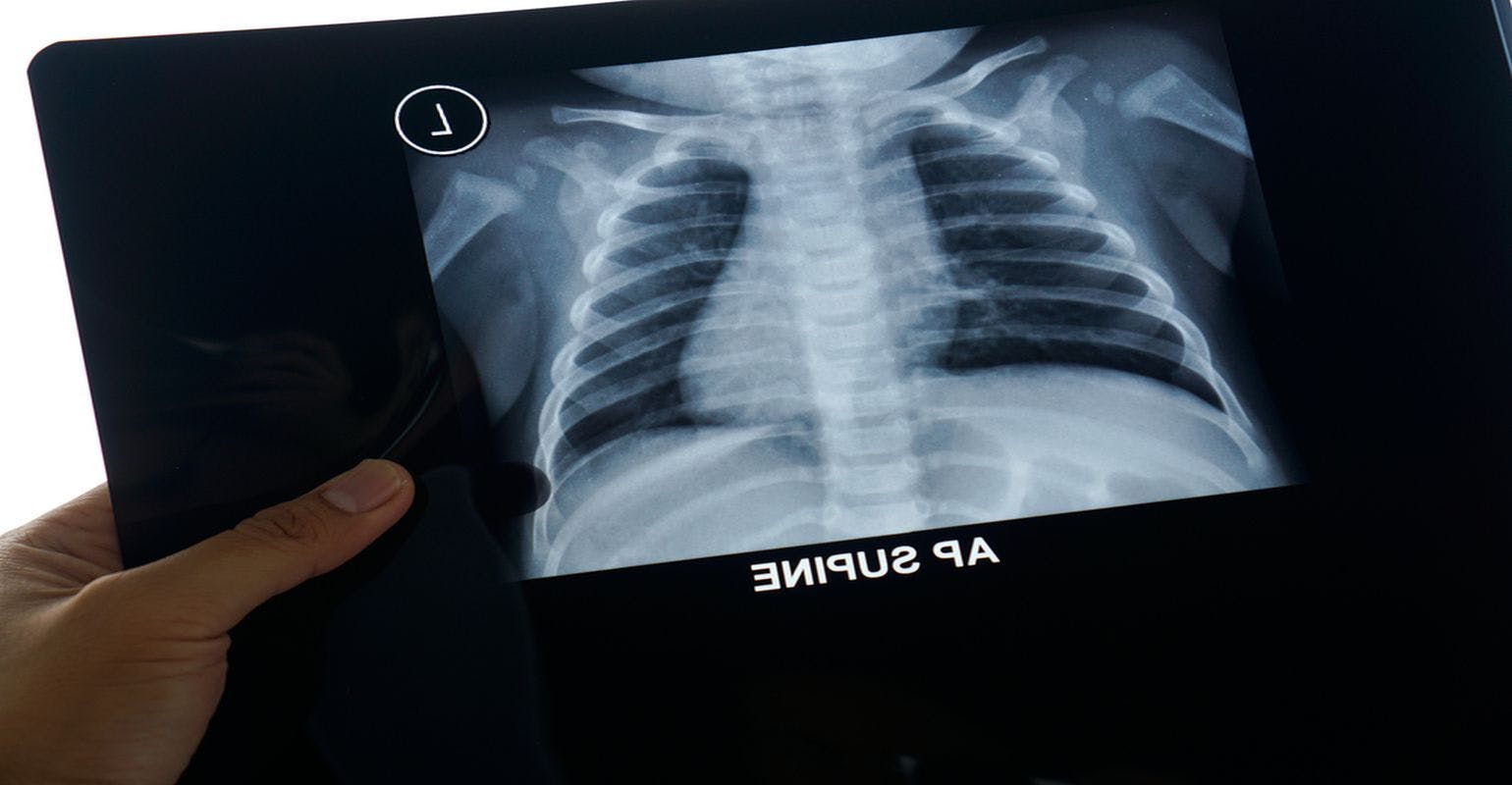 Many Kids with Pneumonia Get Unnecessary Antibiotics, Chest X-Rays