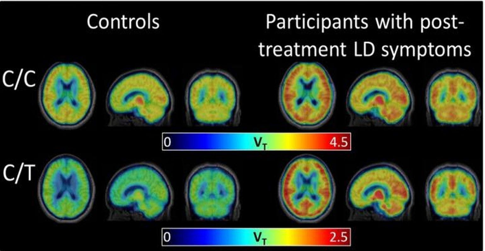 New Scan Technique Reveals Brain Inflammation Associated With Post-Treatment Lyme Disease Syndrome