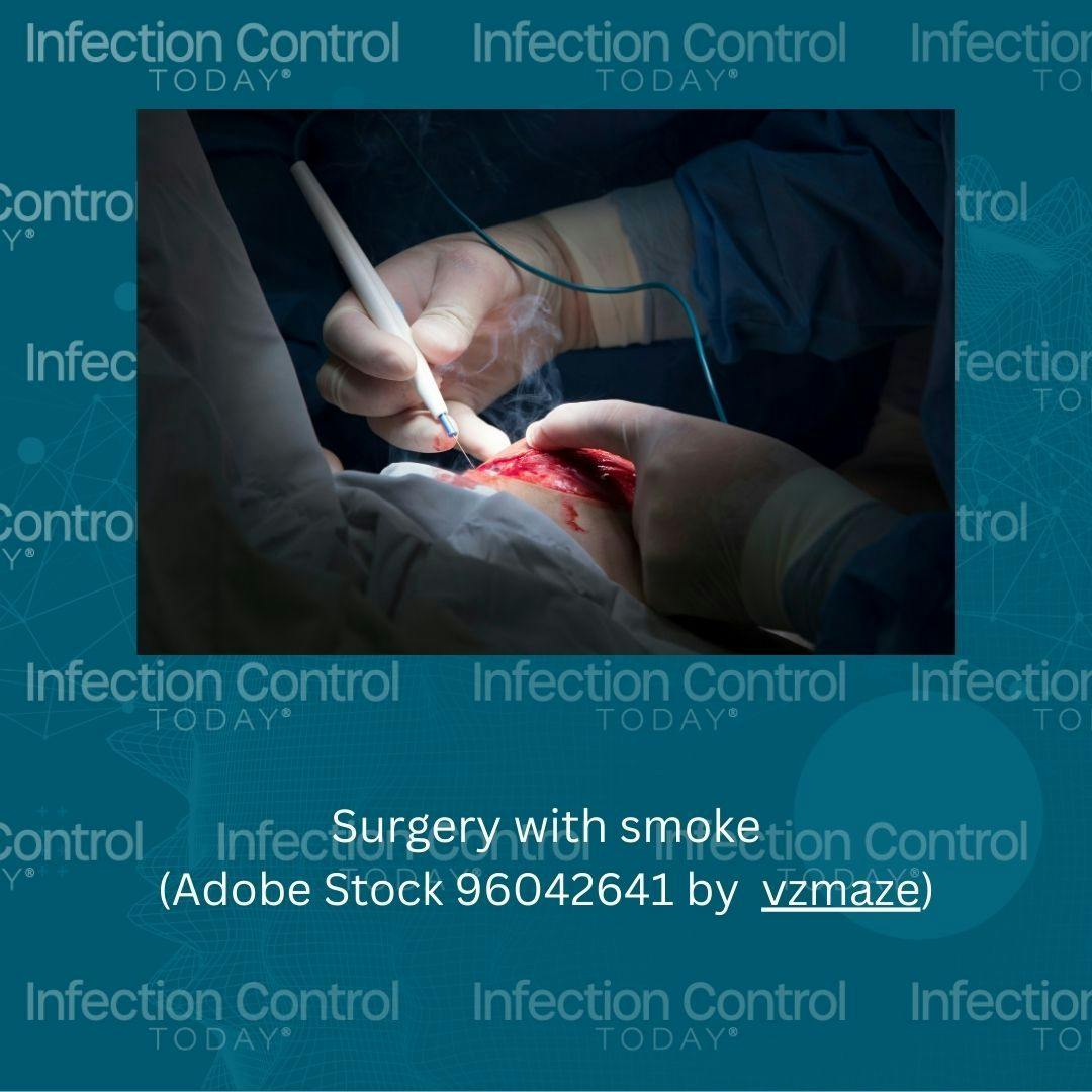 Surgery with smoke  (Adobe Stock 96042641) 