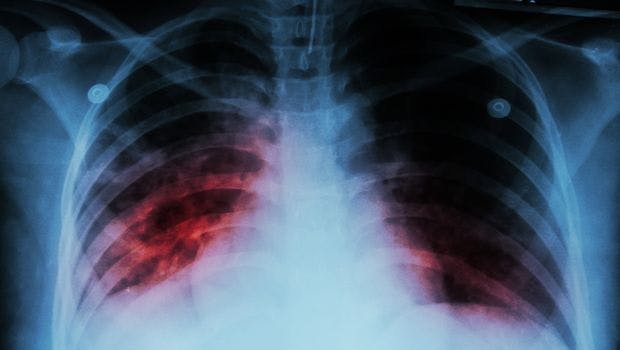 IDSA Guidelines Recommend Newer Tests to Diagnose Tuberculosis