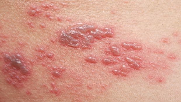 Vaccination May Reduce Cases of Serious Shingles Complications in Seniors