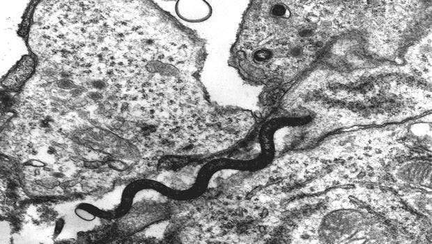 Re-Emergence of Syphilis Traced to Pandemic Strain Cluster