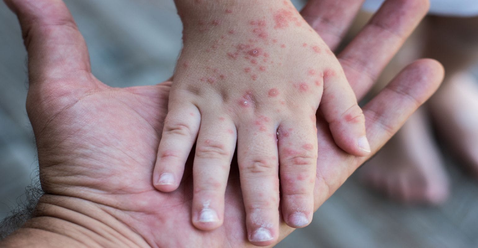 U.S. Measles Cases are the Highest Since the Disease was Eliminated in 2000