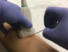 Ultrasound-guided peripheral intravenous from Gottlieb line placement. Reproduced from Gottlieb M. West J Emerg Med 2017; 18(6):1047-1054.