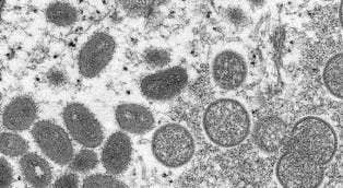 monkeypox seen under a microscope