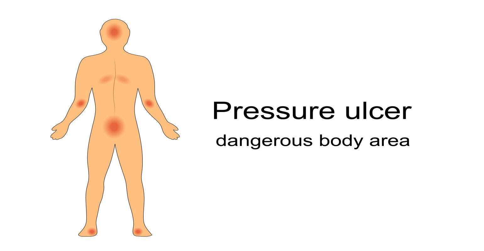 Efforts to Prevent Pressure Ulcers in Hospital Patients May Not be Making Headway on the Worst Kind