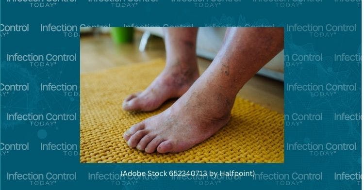A close-up shot of a man's feet with diabetic foot complications.  (Adobe Stock 652340713 by Halfpoint) 