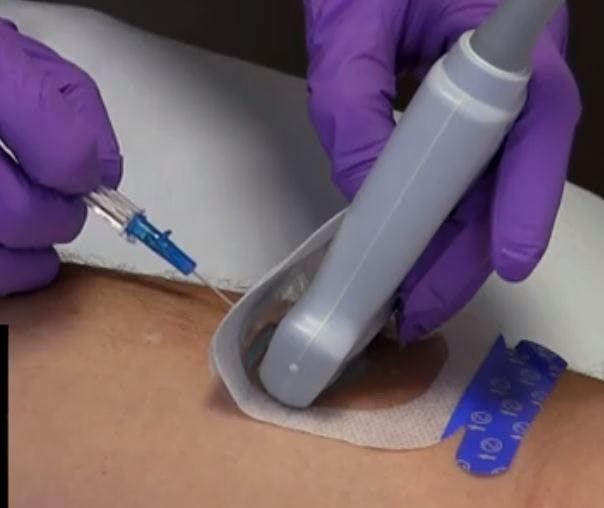 Ultrasound transducer with barrier dressing (Image courtesy PICC Excellence, Hartwell, GA)