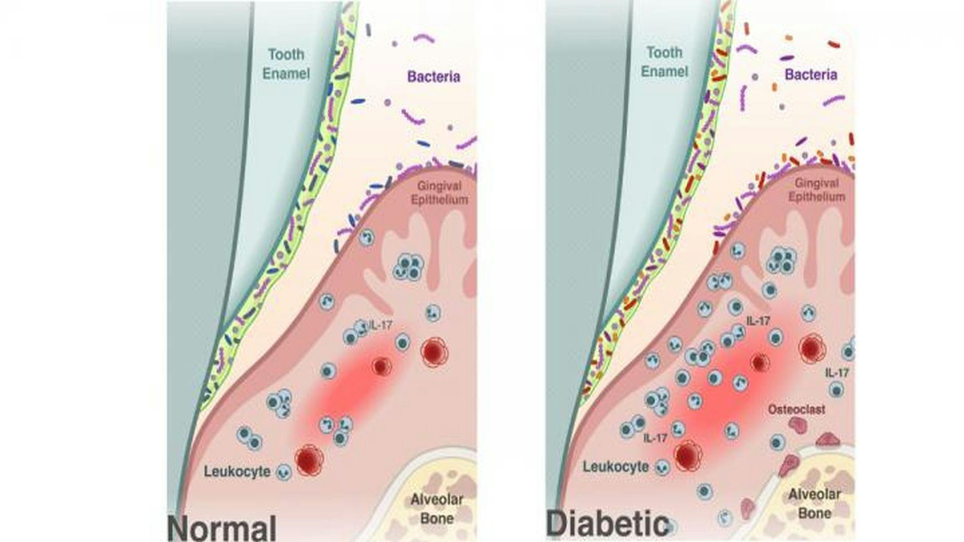 Diabetes Causes Shift in Oral Microbiome That Fosters Periodontitis
