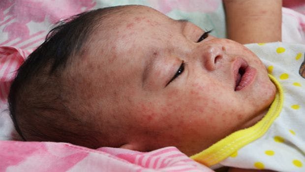 Measles Vaccine Increases Child Survival Beyond Protecting Against Measles