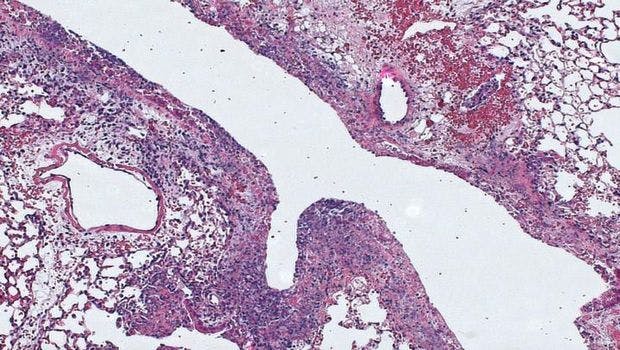 Pneumonia Discovery May Offer Way to Boost Body's Defenses