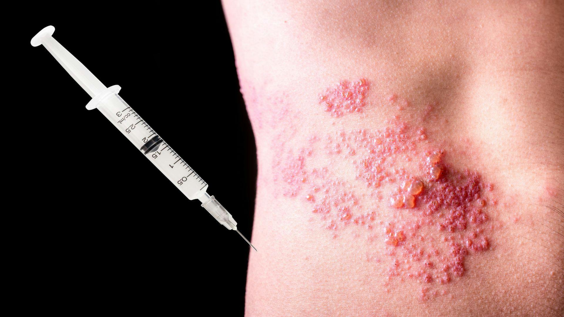 Studies Reveal How Shingles Vaccine Should be Used in Arthritis Patients
