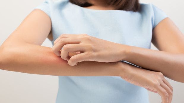 Itchy Inflammation of Mosquito Bites Helps Viruses Replicate