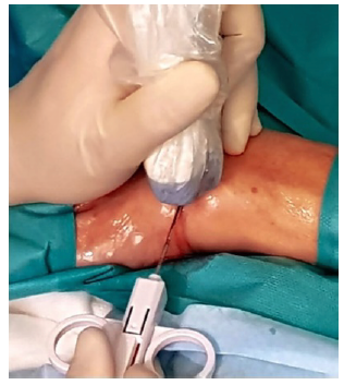 Insertion of biopsy needle during ultrasound-guided synovial biopsy. Reproduced from Saraiva F. Front Med (Lusanne) 2021; 8:632224.
