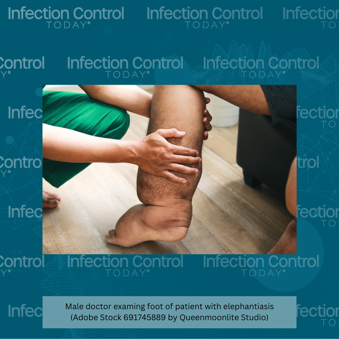 Male doctor examining foot of patient with elephantiasis, one of the neglected tropical diseases (NTDs).   (Adobe Stock 691745889 by Qeenmoonlite Studio)