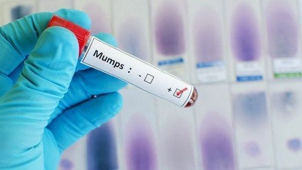 What You Should Know About Mumps: A Disease From the Past Makes a Resurgence