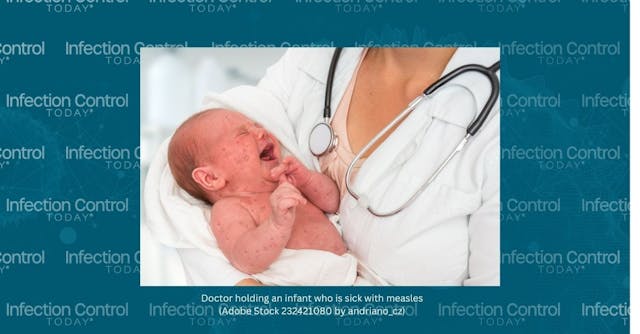 Doctor is holding an infant who is sick with measles.  (Adobe Stock 232421080 by andriano_cz)