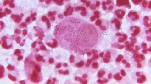 A photomicrograph of a gram-stained specimen demonstrating the presence of gram-negative diplococci, indicative of gonorrhea infection.