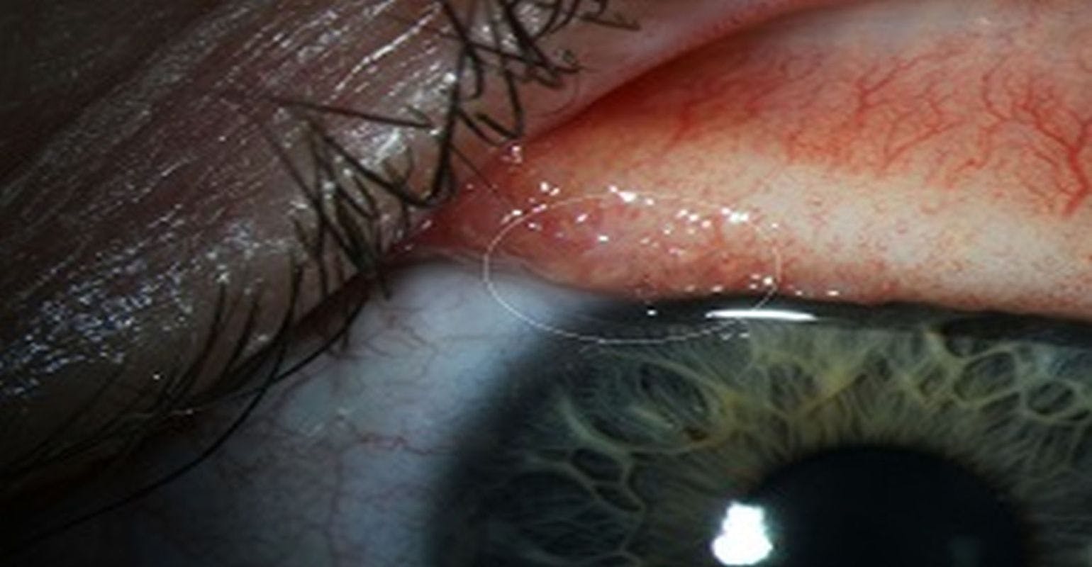 OHSU, CDC Unravel Mysterious Eye Infection
