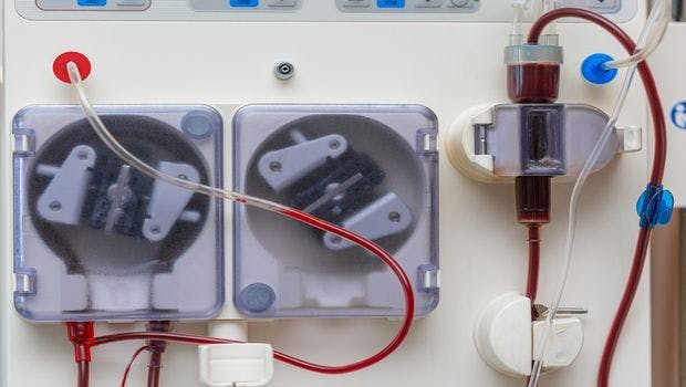 Catheters Linked to Most Bloodstream Infections in Dialysis Patients