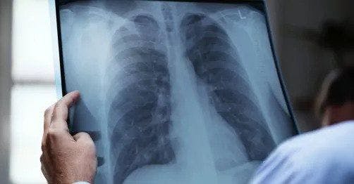 Integrated Data Vital in Stopping Spread of TB